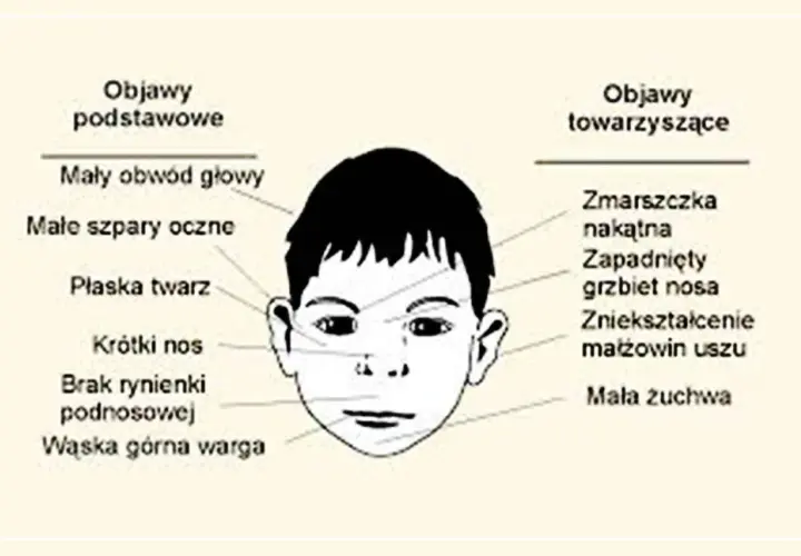 Ilustracja twarzy dziecka z zaznaczonymi objawami FAS: mały obwód głowy, płaska twarz, krótki nos, wąska warga, zmarszczka nakątna.